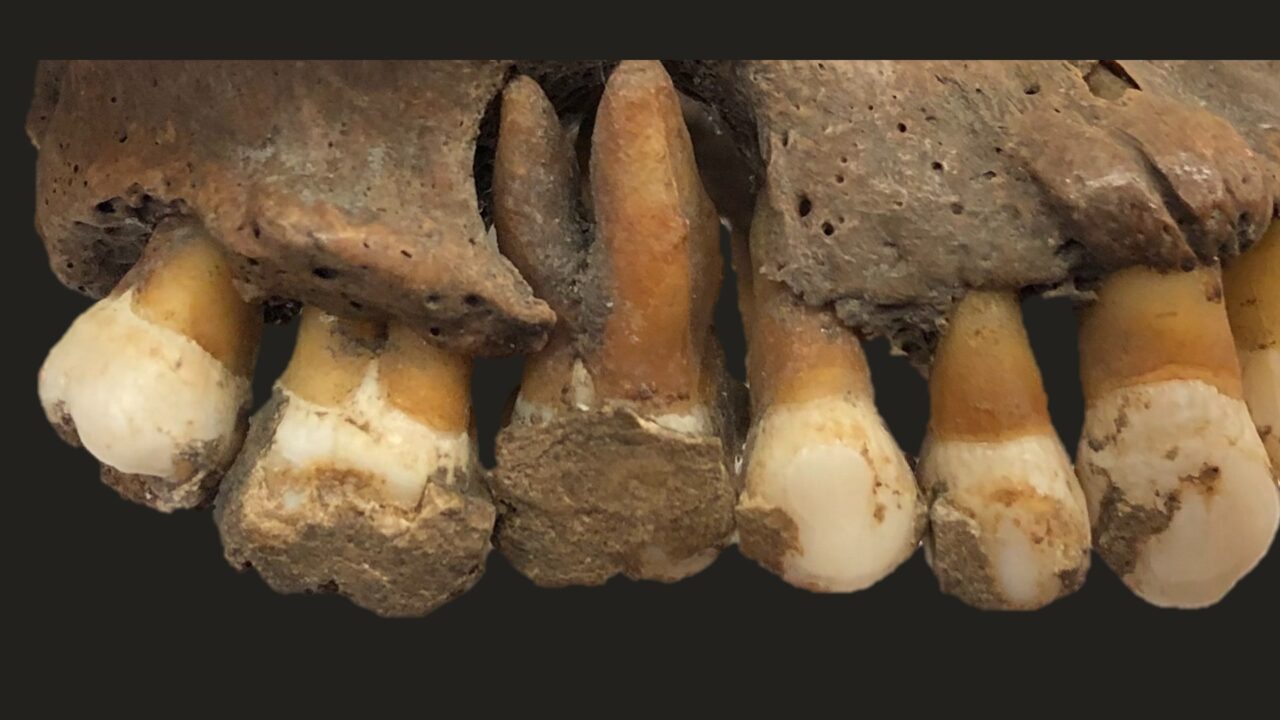 Épais dépôts de tartre sur les dents d’une mâchoire humaine ancienne