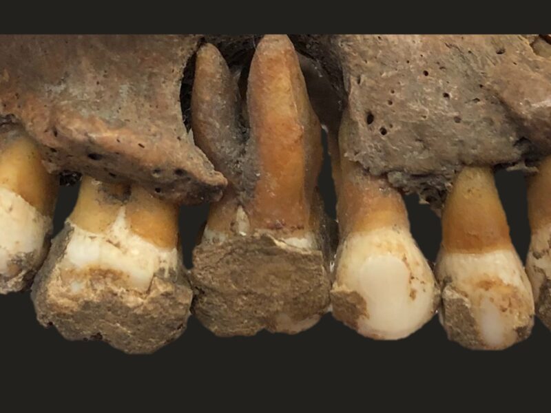 Épais dépôts de tartre sur les dents d’une mâchoire humaine ancienne